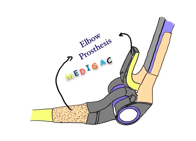 Total elbow replacement prosthesis